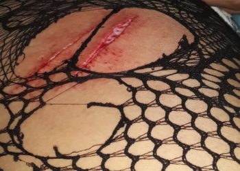 Una mujer fue víctima de múltiples puñaladas, salvó la vida por milagro pero caratularon como “lesiones” y el agresor continúa en libertad