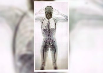 Detuvieron a una joven de 20 años con 78 cápsulas de cocaína en el cuerpo