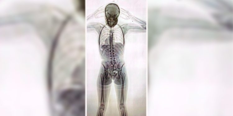 Detuvieron a una joven de 20 años con 78 cápsulas de cocaína en el cuerpo