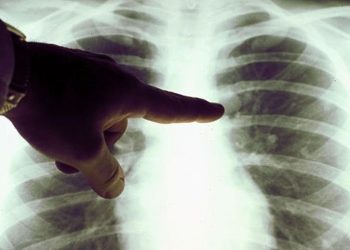 Amivantamab: las claves del nuevo tratamiento contra el cáncer de pulmón aprobado por la ANMAT