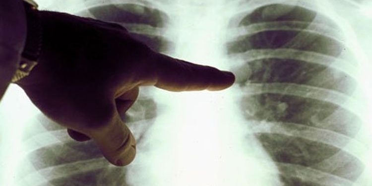 Amivantamab: las claves del nuevo tratamiento contra el cáncer de pulmón aprobado por la ANMAT