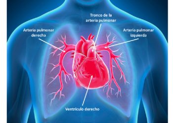 Una nueva opción terapéutica llega a la argentina para los pacientes adultos con hipertensión arterial pulmonar