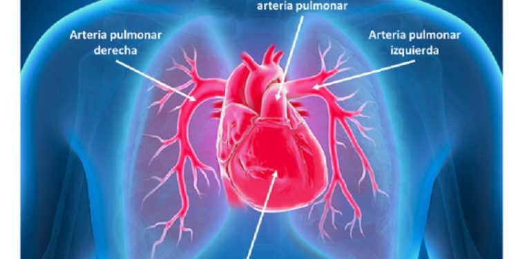 Una nueva opción terapéutica llega a la argentina para los pacientes adultos con hipertensión arterial pulmonar
