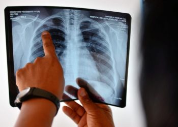 Tuberculosis: en medio de una suba de casos, el Ministerio de Salud eliminó la coordinación del área