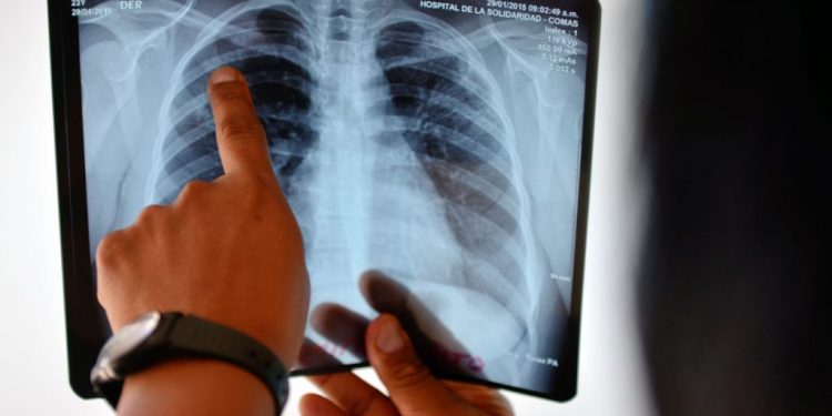Tuberculosis: en medio de una suba de casos, el Ministerio de Salud eliminó la coordinación del área