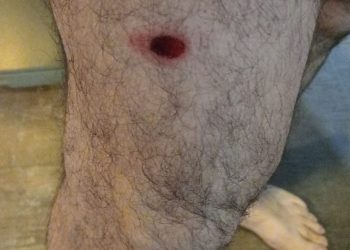 El fotógrafo de Tiempo Edgardo Gómez, herido por las balas de goma de la policía