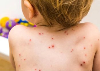 Empezó la campaña de refuerzo contra el sarampión: de 6 meses a 5 años, sin turno