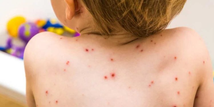 Empezó la campaña de refuerzo contra el sarampión: de 6 meses a 5 años, sin turno